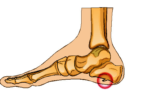 ankle bone spur