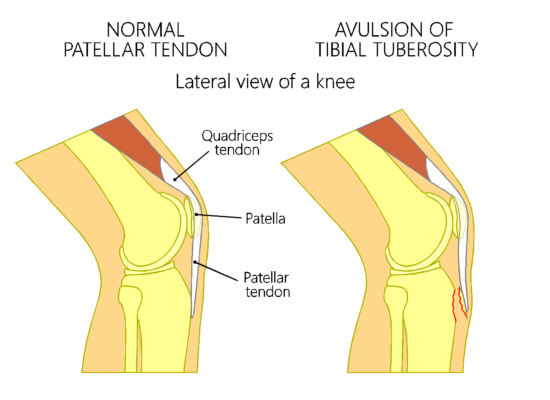 Bone Fractures - Convergent Movement and Performance LLC