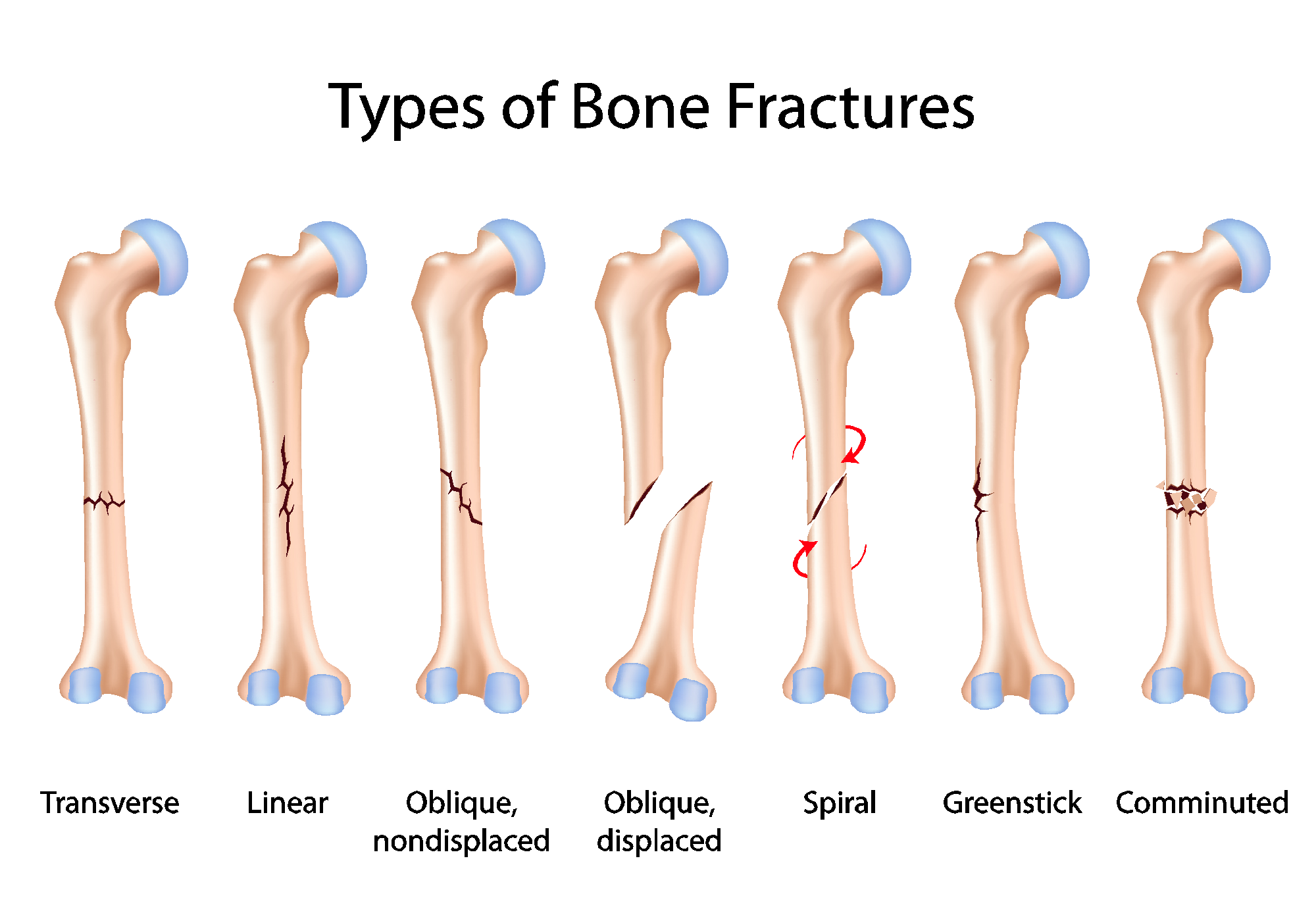 Bone Fractures - Convergent Movement and Performance LLC